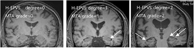 Correlation Between Hippocampal Enlarged Perivascular Spaces and Cognition in Non-dementic Elderly Population